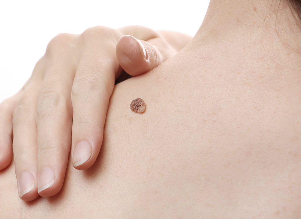 피부질환 병변성 피부질환