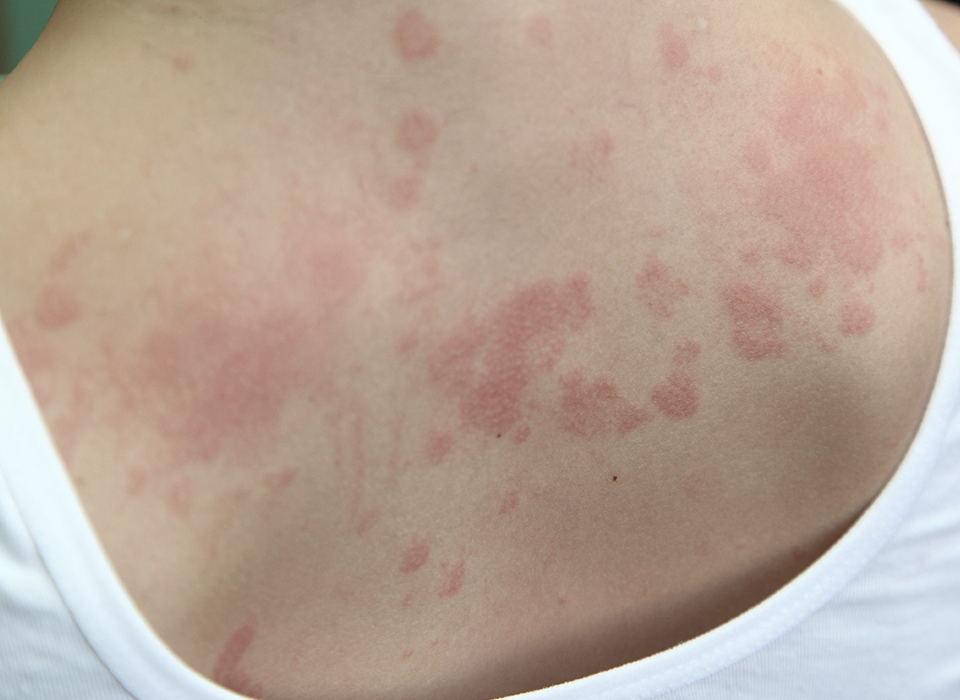 피부질환 아토피 피부염