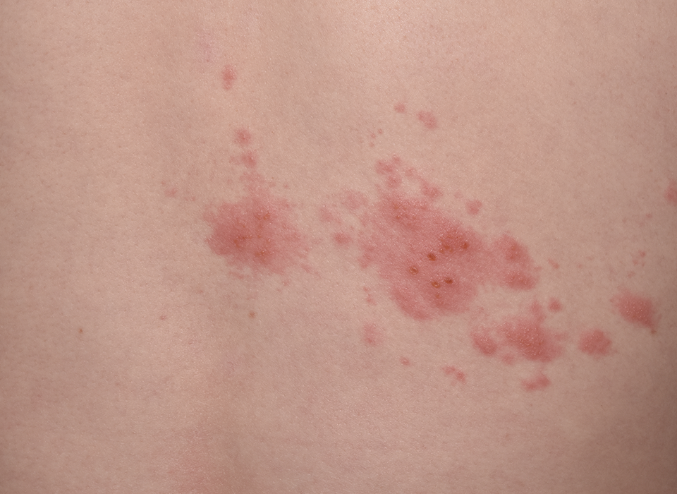 피부질환 대상포진